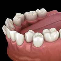 Digital image of crowded teeth