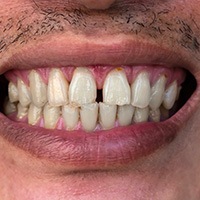 Person with gapped teeth