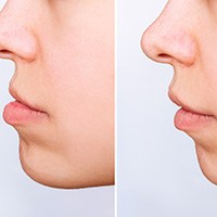 Side-by-side images of an underbite