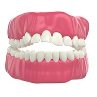 Digital image of an open bite