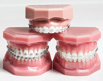 Stacks of mouth molds with braces